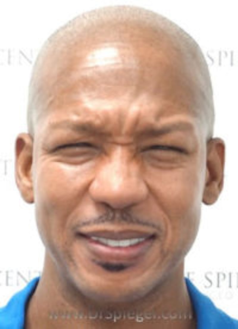 Botox / Dysport / Jeuveau / Xeomin Before & After Gallery - Patient 971595 - Image 1