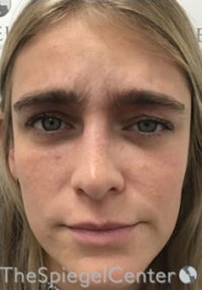 Botox / Dysport / Jeuveau / Xeomin Before & After Gallery - Patient 362801 - Image 1