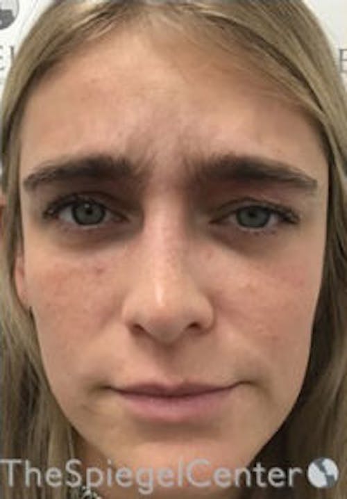 Botox / Dysport / Jeuveau / Xeomin Before & After Gallery - Patient 362801 - Image 1