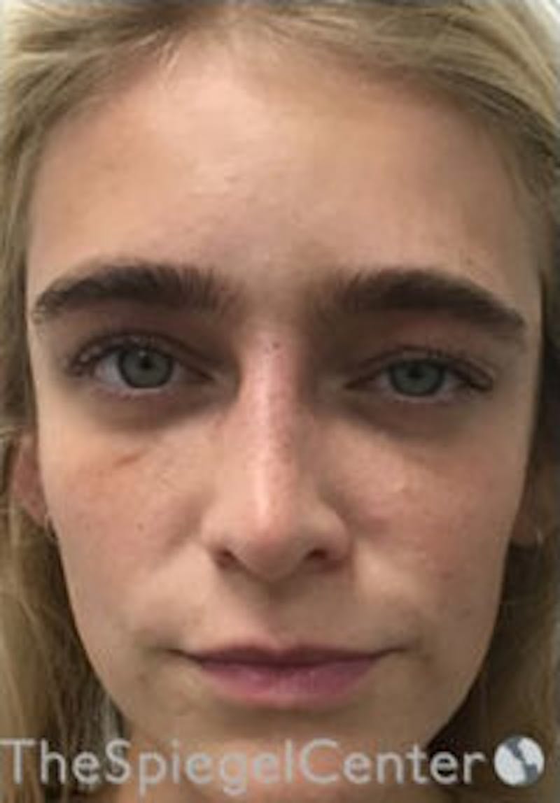 Botox / Dysport / Jeuveau / Xeomin Before & After Gallery - Patient 362801 - Image 2