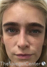 Botox / Dysport / Jeuveau / Xeomin Before & After Gallery - Patient 362801 - Image 2