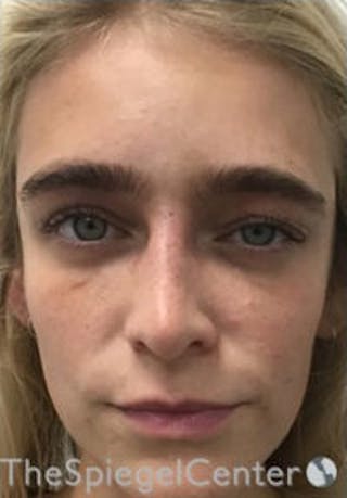 Botox / Dysport / Jeuveau / Xeomin Before & After Gallery - Patient 362801 - Image 2