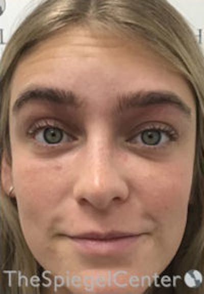 Botox / Dysport / Jeuveau / Xeomin Before & After Gallery - Patient 362801 - Image 3