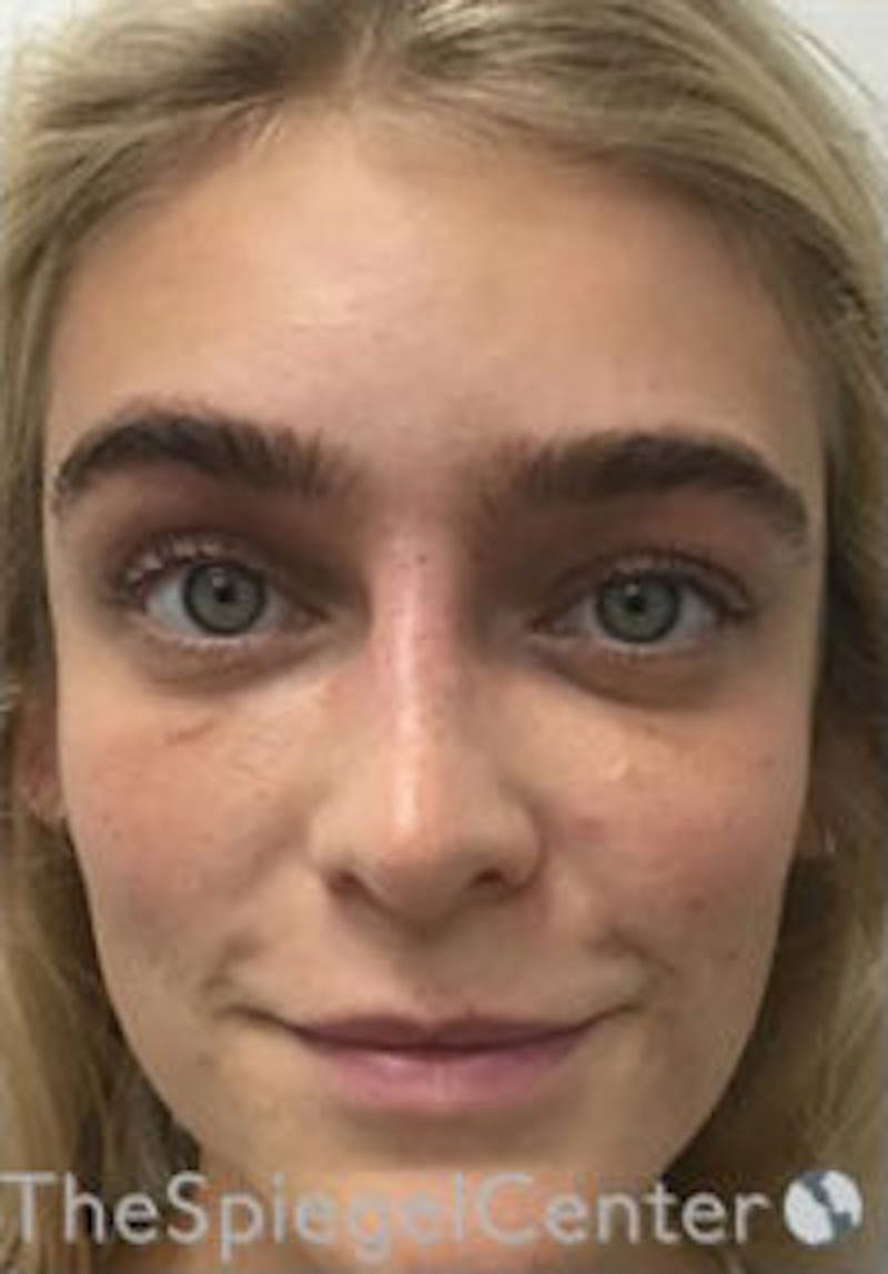 Botox / Dysport / Jeuveau / Xeomin Before & After Gallery - Patient 362801 - Image 4