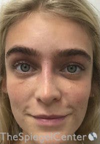 Botox / Dysport / Jeuveau / Xeomin Before & After Gallery - Patient 362801 - Image 4
