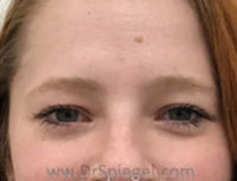 Botox Browlift Before & After Gallery - Patient 408162 - Image 1