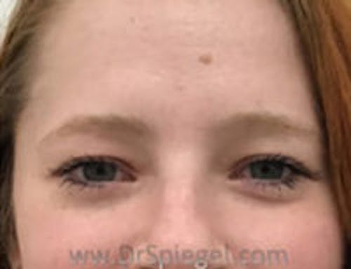 Botox Brow Lift Before & After Gallery - Patient 408162 - Image 1