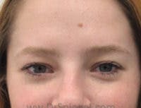Botox Brow Lift Before & After Gallery - Patient 408162 - Image 2