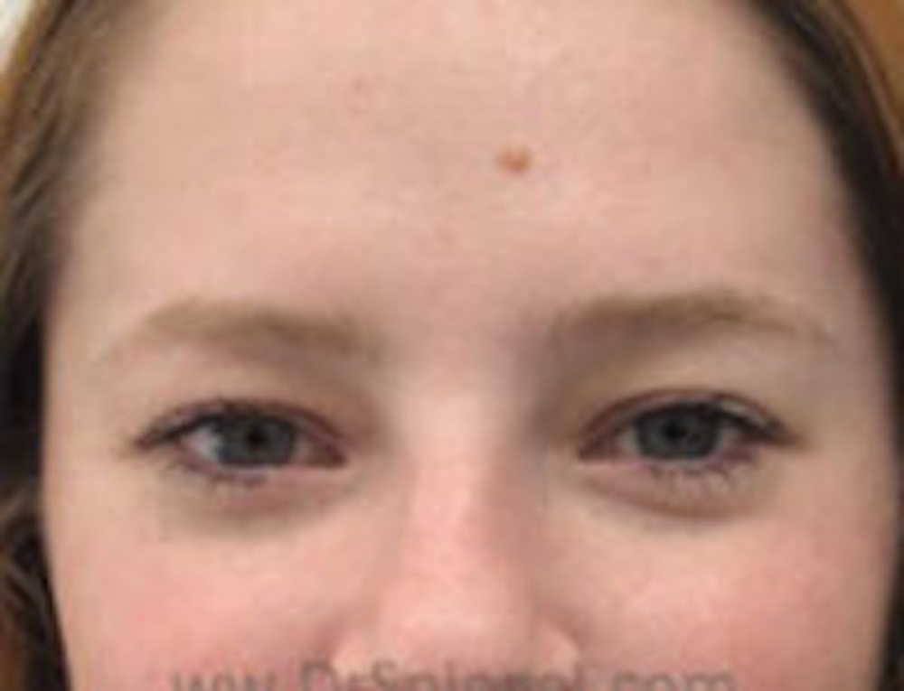 Non-Surgical Brow Lift