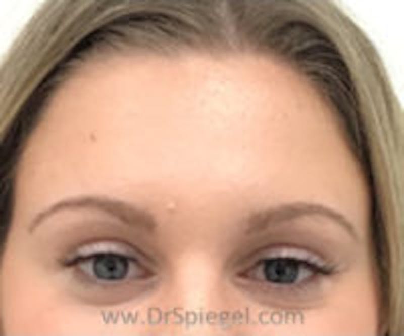Botox Browlift Before & After Gallery - Patient 122786 - Image 1