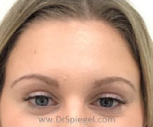 Botox Brow Lift Before & After Gallery - Patient 122786 - Image 1