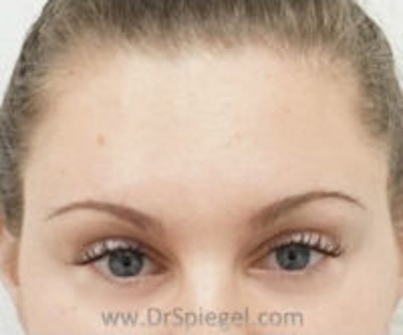 Botox Browlift Before & After Gallery - Patient 122786 - Image 2