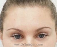 Botox Brow Lift Before & After Gallery - Patient 122786 - Image 2