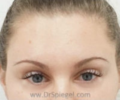 Botox Browlift Before & After Gallery - Patient 122786 - Image 2