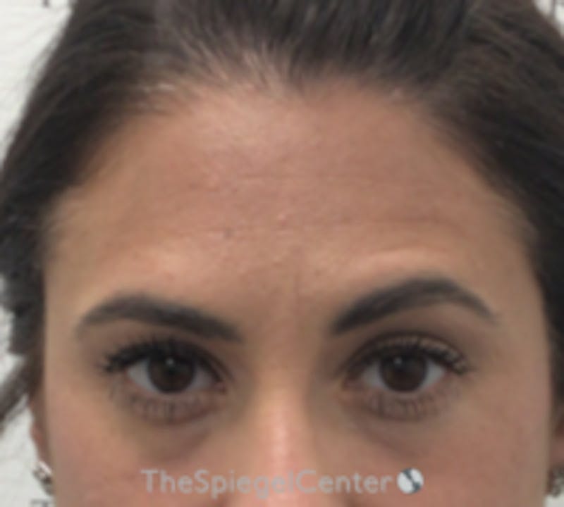 Botox Browlift Before & After Gallery - Patient 389927 - Image 1