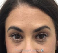 Botox Brow Lift Before & After Gallery - Patient 389927 - Image 2