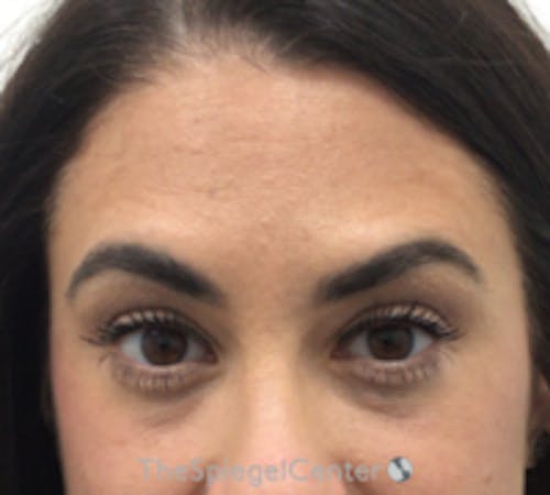 Botox Brow Lift Before & After Gallery - Patient 389927 - Image 2
