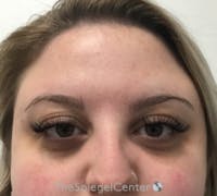 Botox Brow Lift Before & After Gallery - Patient 208359 - Image 1