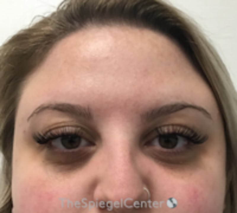 Botox Browlift Before & After Gallery - Patient 208359 - Image 1