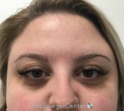 Botox Browlift Before & After Gallery - Patient 208359 - Image 1