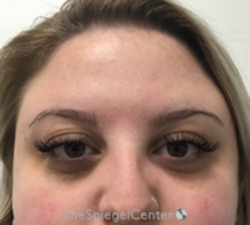 Botox Brow Lift Before & After Gallery - Patient 208359 - Image 1