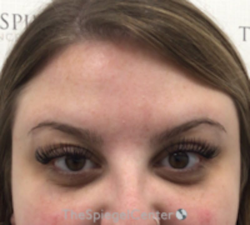 Botox Browlift Before & After Gallery - Patient 208359 - Image 2