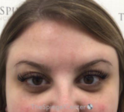 Botox Browlift Before & After Gallery - Patient 208359 - Image 2