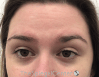 Botox Brow Lift Before & After Gallery - Patient 342211 - Image 1