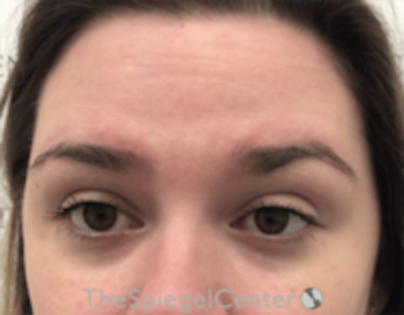 Botox Browlift Before & After Gallery - Patient 342211 - Image 1