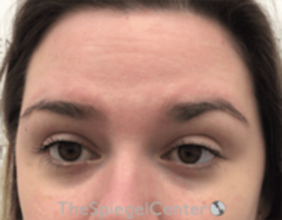Botox Browlift Before & After Gallery - Patient 342211 - Image 1