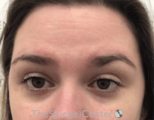 Botox Brow Lift Before & After Gallery - Patient 342211 - Image 1