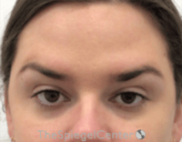 Botox Brow Lift Before & After Gallery - Patient 342211 - Image 2