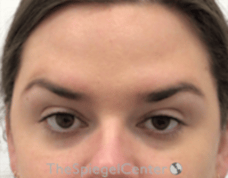 Botox Browlift Before & After Gallery - Patient 342211 - Image 2