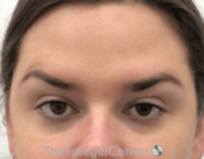 Botox Browlift Before & After Gallery - Patient 342211 - Image 2