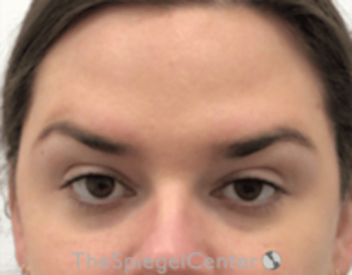 Botox Brow Lift Before & After Gallery - Patient 342211 - Image 2