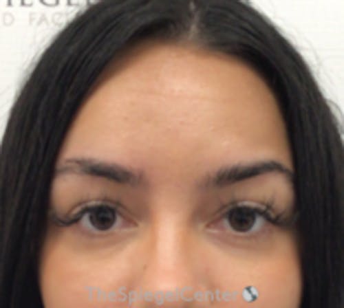 Botox Brow Lift Before & After Gallery - Patient 344637 - Image 1