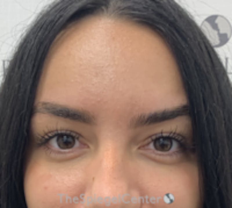 Botox Browlift Before & After Gallery - Patient 344637 - Image 2