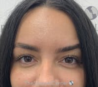 Botox Brow Lift Before & After Gallery - Patient 344637 - Image 2