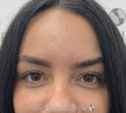Botox Brow Lift Before & After Gallery - Patient 344637 - Image 2