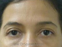 Botox Brow Lift Before & After Gallery - Patient 392185 - Image 1