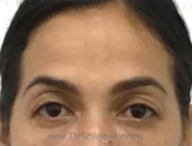 Botox Browlift Before & After Gallery - Patient 392185 - Image 2
