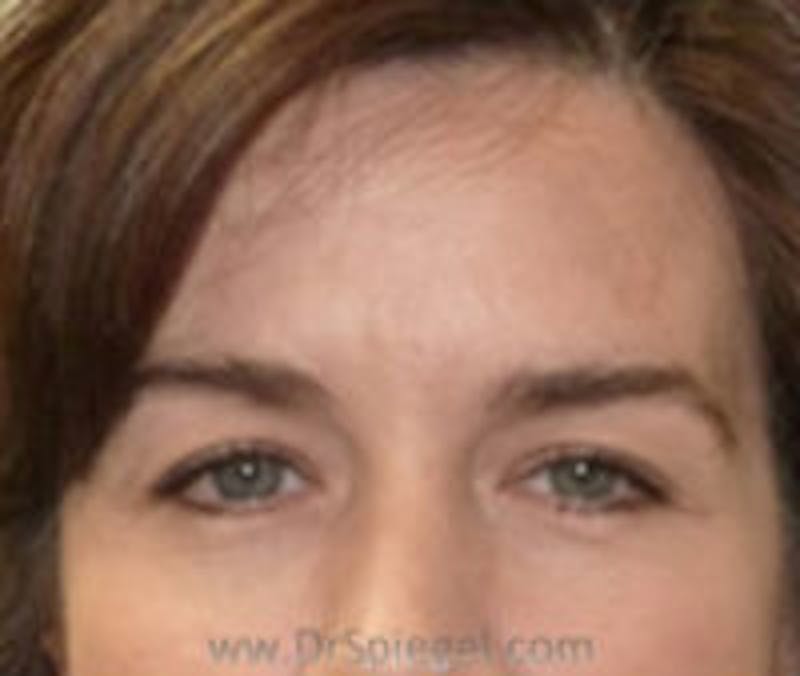 Botox Browlift Before & After Gallery - Patient 300595 - Image 1
