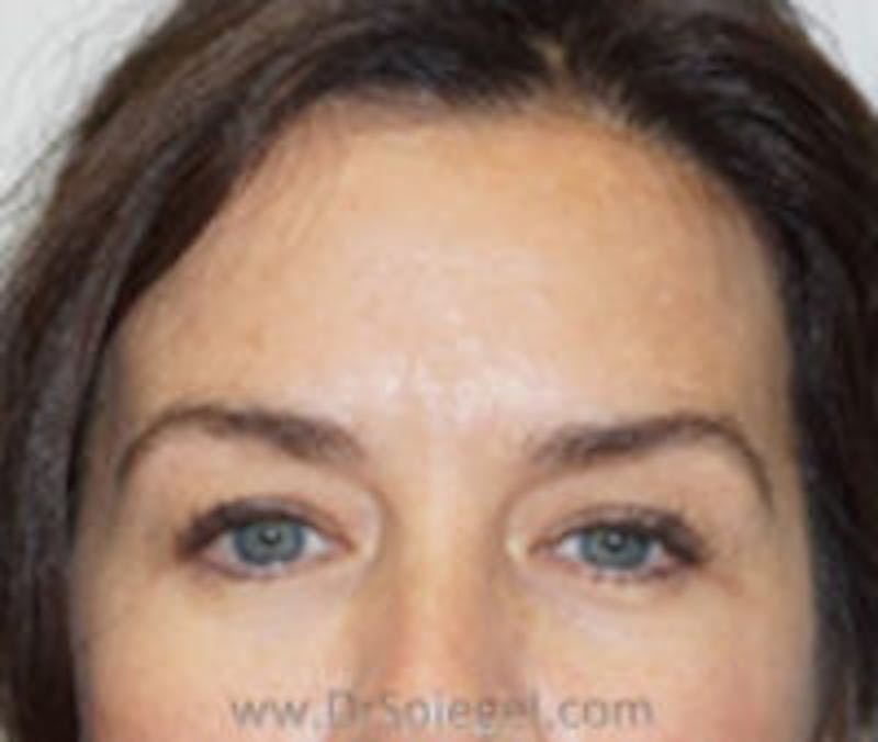 Botox Browlift Before & After Gallery - Patient 300595 - Image 2
