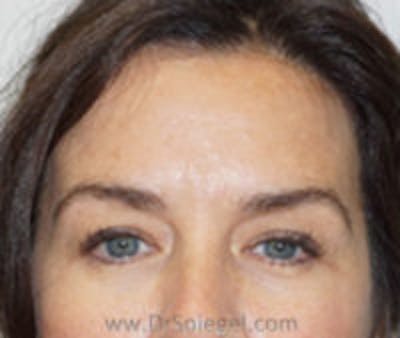 Botox Browlift Before & After Gallery - Patient 300595 - Image 2