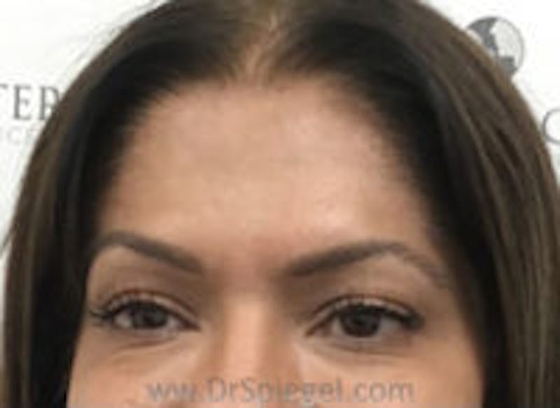 Botox Browlift Before & After Gallery - Patient 139560 - Image 2