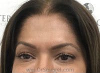 Botox Brow Lift Before & After Gallery - Patient 139560 - Image 2