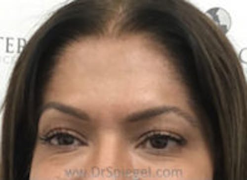 Botox Brow Lift Before & After Gallery - Patient 139560 - Image 2