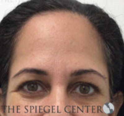 Botox Browlift Before & After Gallery - Patient 219072 - Image 1