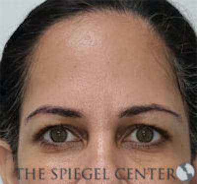 Botox Browlift Before & After Gallery - Patient 219072 - Image 2