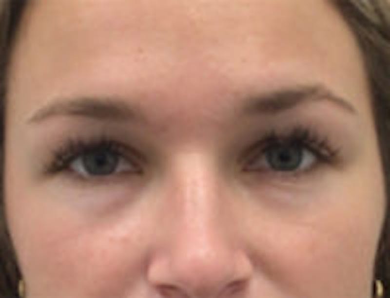 Botox Browlift Before & After Gallery - Patient 269652 - Image 1